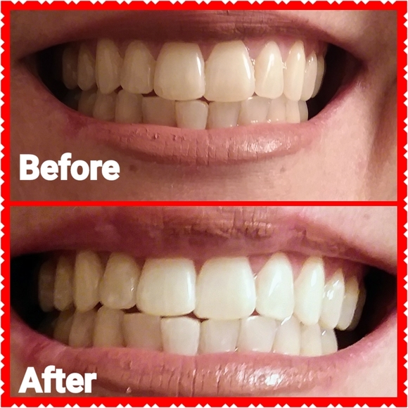 Smartphone Whitening Kit - Picture 3 of 4